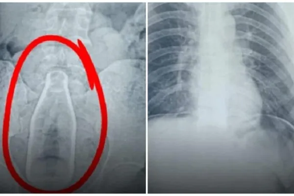 Pudukottai: மாற்று திறனாளி வயிற்றில் கண்ணாடி பாட்டில் அதிர்ந்த மருத்துவர்கள்!