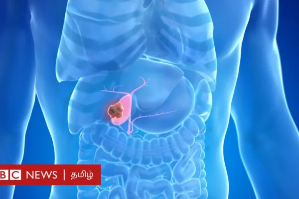 பித்தப்பை புற்றுநோய்: எந்தெந்த அறிகுறிகளை அலட்சியம் செய்யக்கூடாது? யாருக்கு வரும் வாய்ப்பு அதிகம்?