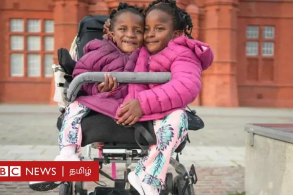 ஒட்டிப் பிறந்த இரட்டை சகோதரிகள்: பிழைக்க வாய்ப்பில்லை என்று மருத்துவர்கள் கூறியதை பொய்யாக்கிய கதை