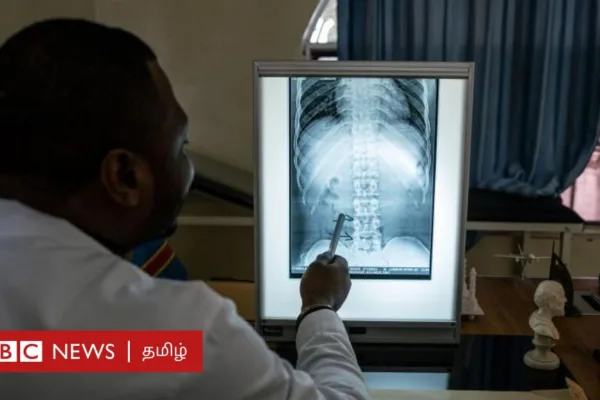 முதுகு வலி: பள்ளி மாணவர், இளைஞர்களுக்கு முதுகுவலி வருவது ஏன்? மருத்துவரை எப்போது அணுக வேண்டும்?