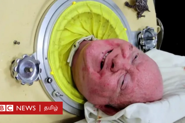 பால் அலெக்சாண்டர்: இரும்பு நுரையீரலுடன் 78 ஆண்டுகள் வாழ்ந்த அதிசய மனிதர் - ஏன்? யார் இவர்?